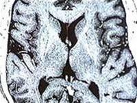 Find out the cause of schizophrenia