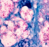 Find out the oldest infectious bacteria of humanity