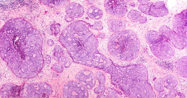 Finding 110 new genes causes breast cancer