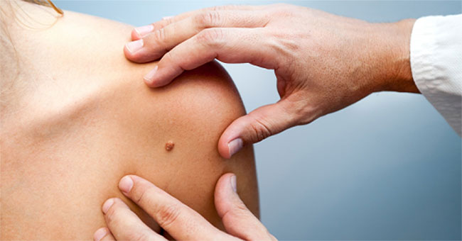 First blood test to detect melanoma early