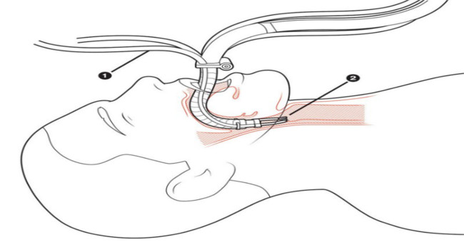 Flex - Robot snakes into the body through the mouth for surgery