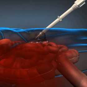 Foam hemostatic internal injury