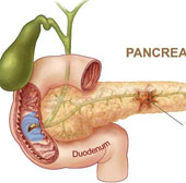 Food poisoning bacteria help treat pancreatic cancer