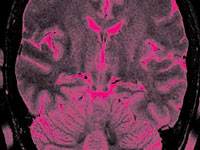 For the first time, brain tumors do not open the skull