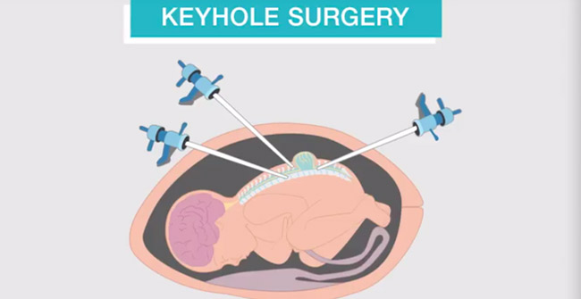 For the first time in the UK, the fetus is operated on while still in the womb