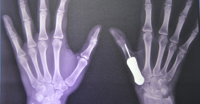 For the first time the world successfully grafted titanium finger