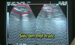 For the first time, Vietnam osteopaths with ultrasound