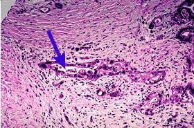 Found stem cells in pancreatic tumors