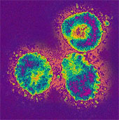 France: Two more suspected cases of SARS virus infection