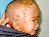 Free face cranial deformities for poor children