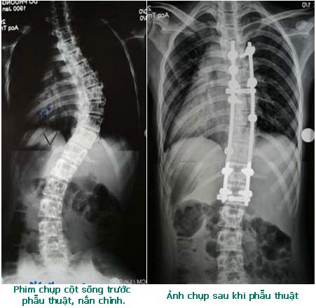 Free scoliosis examination for poor patients