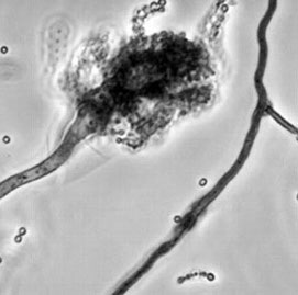 Fungal meningitis continues to spread in the United States
