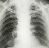 Further detection of new EMC virus causes pneumonia