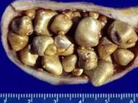 Gallstones and complications