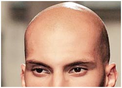 Genetic testing can predict baldness