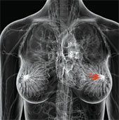 Genetic testing helps change the way breast cancer is treated