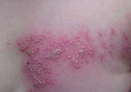Genital tract infection at the beauty salon