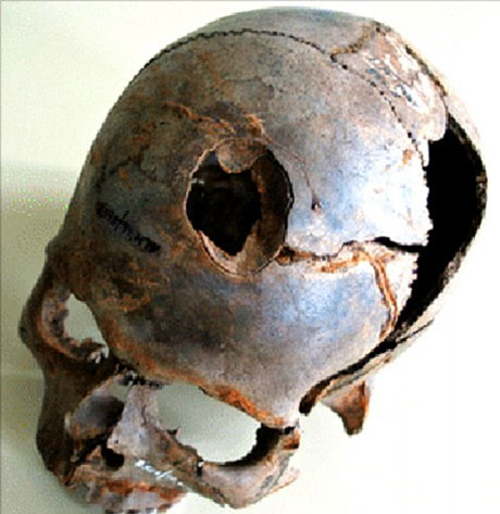 Germany: Detecting ancient battlefields with 100 bodies