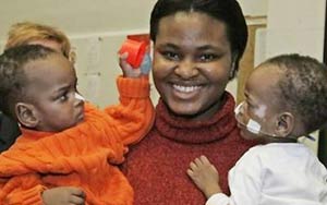 Germany successfully separated 2 babies with belly