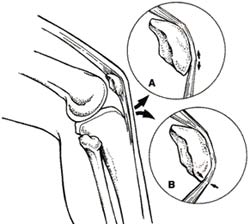 Get the stem cell form in the tendon wire