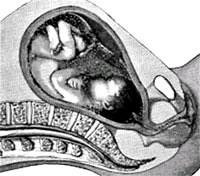 Giant disease in the fetus