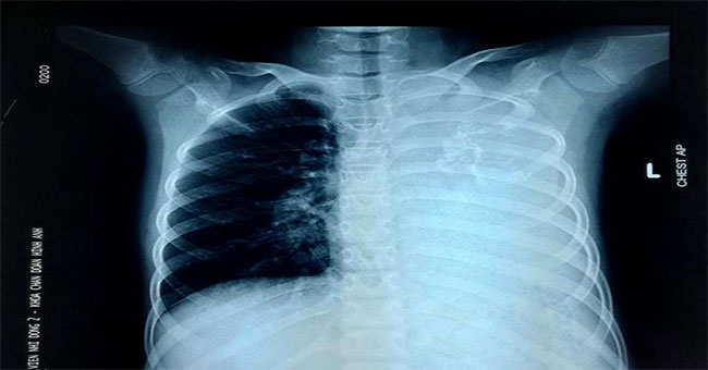 Girls with persistent cough persist because of extremely rare disease, the world has less than 20 cases