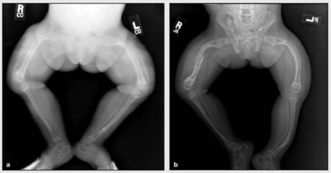 Glass bone disease