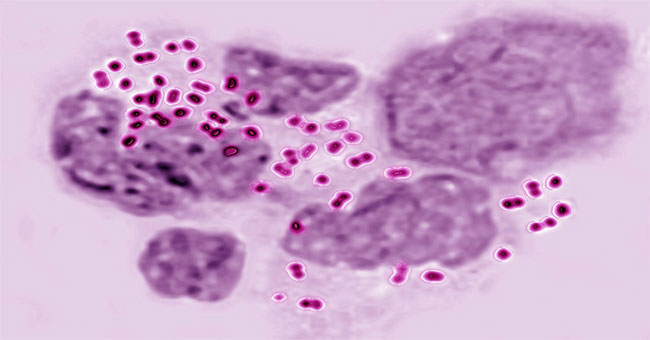Gonorrhea spreads by oral sex