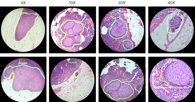 Google created a augmented reality microscope capable of detecting cancer