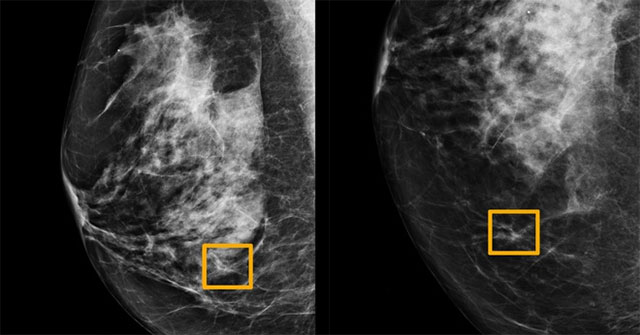 Google's AI determines breast cancer more accurately than doctors