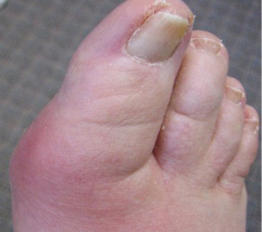 Gout or arthritis?
