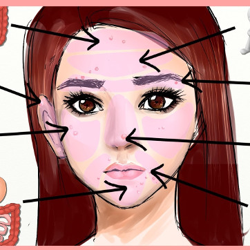 Guess the disease through the location of acne on the face