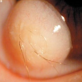 Hair growth in eyeballs