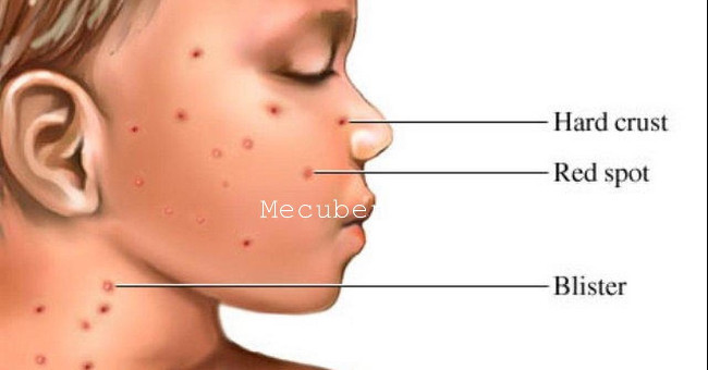 Hand and foot and mouth disease increased in Hanoi