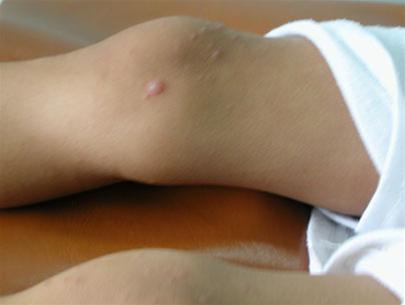 Hand, foot and mouth disease: children can die!