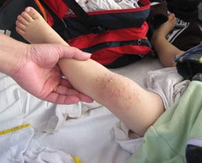 Hand-foot-mouth disease is showing flare up