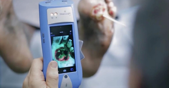 Handheld devices help see bacteria on the wound