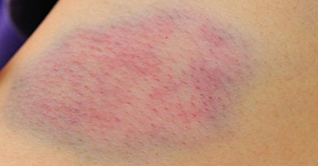 Handle properly when bruising