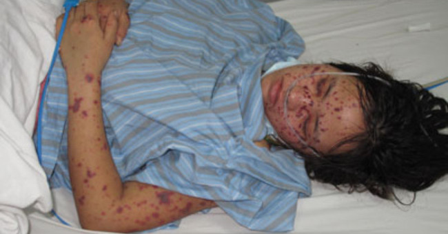 Hanoi recorded the first case of dangerous meningococcal encephalitis