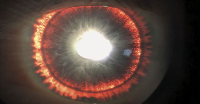 Having a rare illness, the man has eyes like Sauron