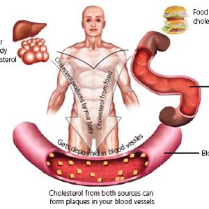 HDL cholesterol reduces the risk of bowel cancer