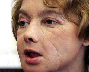 He allowed the whole face transplant surgery