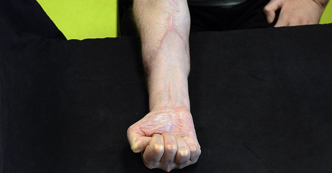 He funded free hand graft surgery