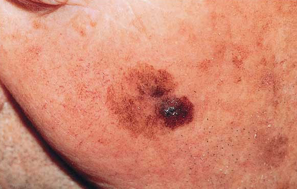 He invented two new drugs to treat melanoma