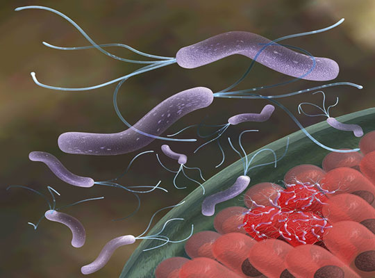 Helicobacter Pylori bacteria helps prevent asthma