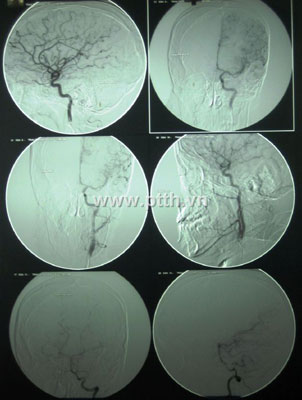 Hemangiectomy by new technique