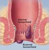 Hemorrhoids: Take medicine or surgery?