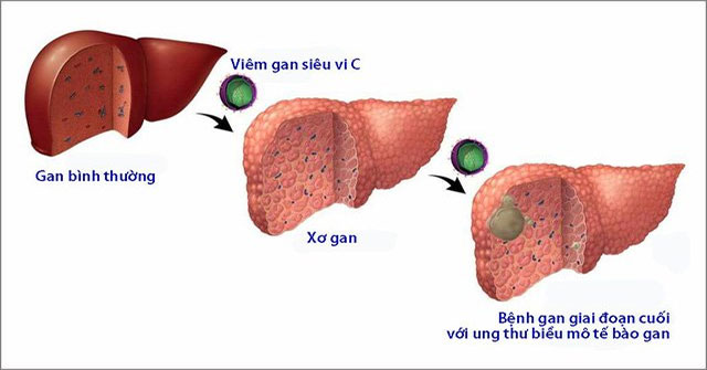 Hepatitis C: Causes, symptoms and treatment
