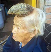 Her grandmother grew a strange long horn on her head