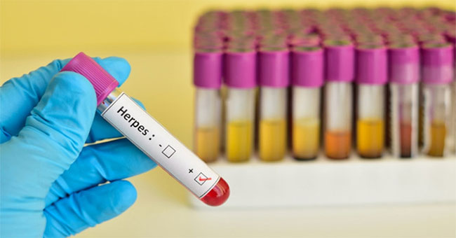 Herpes virus can lead to bipolar disorder and depression